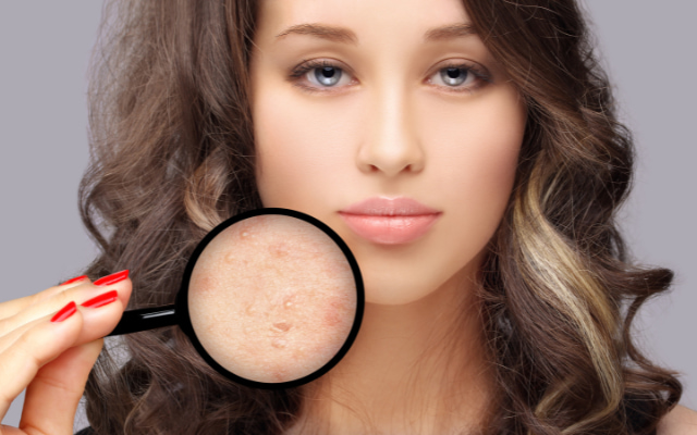 Lợi ích của việc chăm sóc da sau nặn mụn