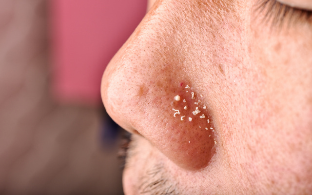 Mụn đầu trắng