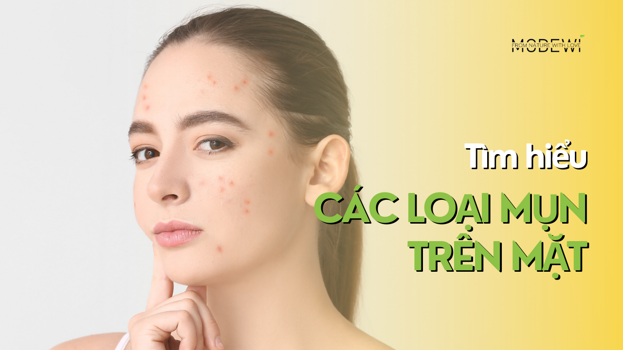 các loại mụn trên mặt